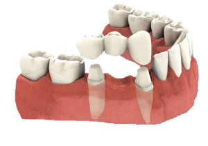 dentist, bridge, teeth