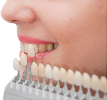 Dental-Veneers