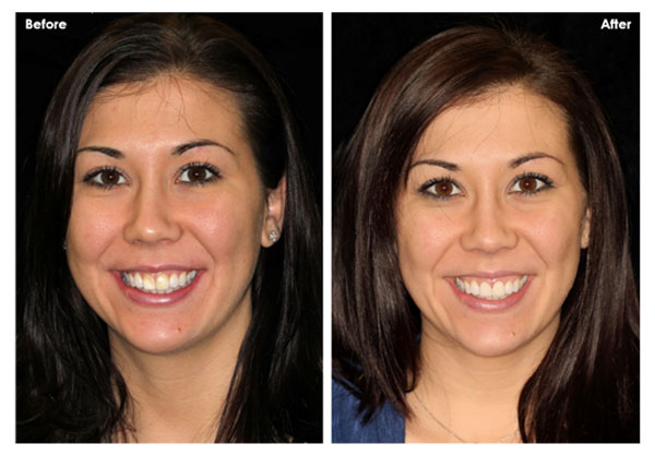 Masking Discolorations with Porcelain Veneers