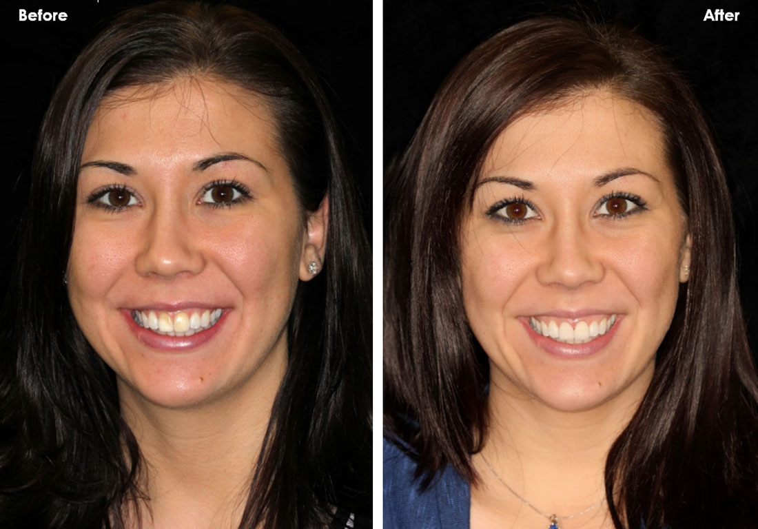 veneers porcelain before teeth dentures dental lisa discolorations masking implants challenge crowns