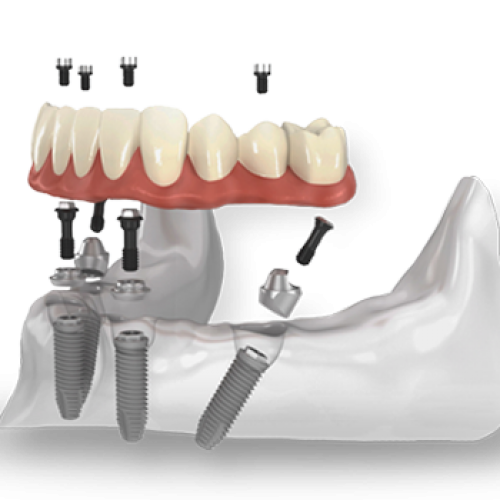 dentist, all-on-4, teeth, jaw