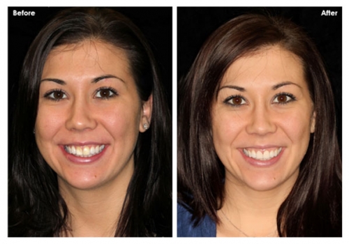 Masking Discolorations with Porcelain Veneers